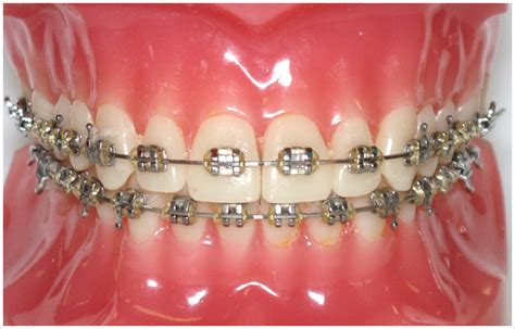 metal orthodontic brackets not corrode|orthodontic wire release.